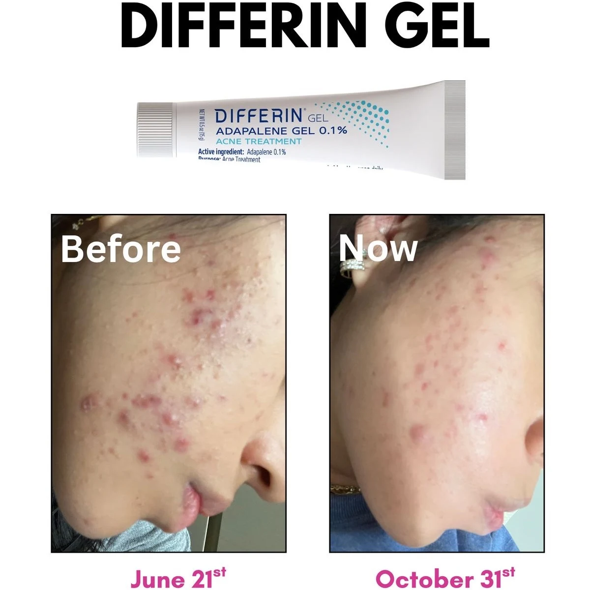 ژل ضد جوش دیفرین مدل Adapalene 1