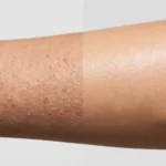 عکس واقعی قبل و بعد درمان پوست مرغی؛ بازوی زبر به پوست صاف و آبرسانی‌شده